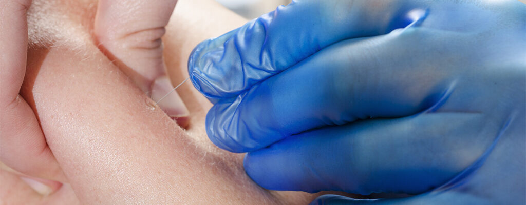 Dry Needling San Antonio, TX