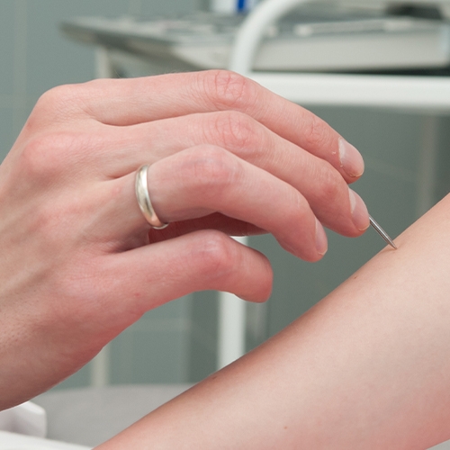 Exploring the Many Benefits of Dry Needling