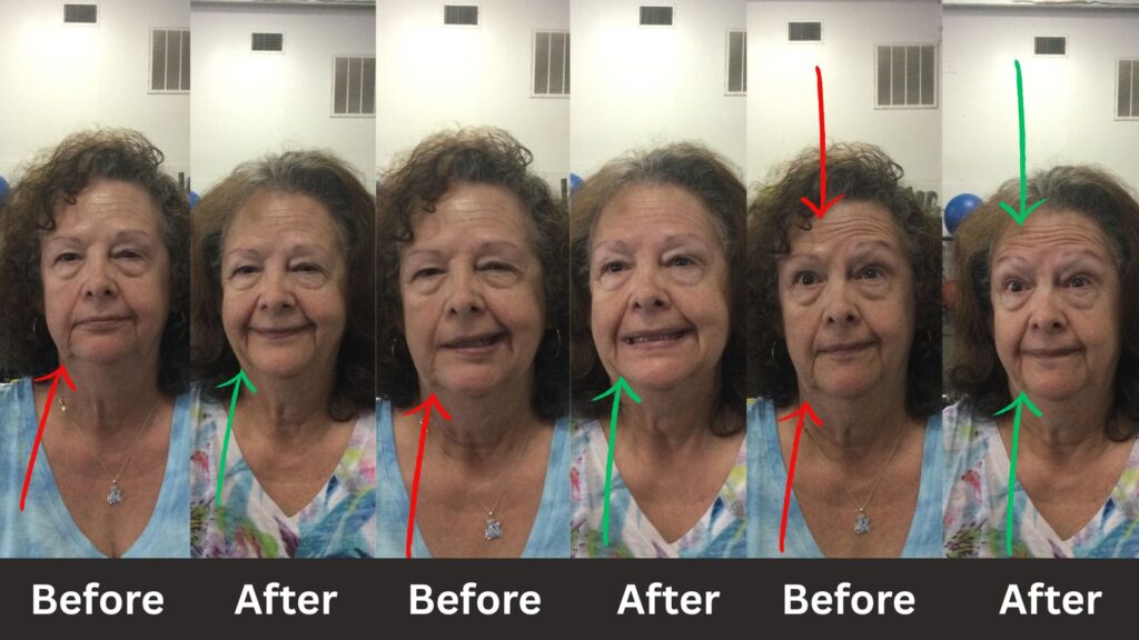 before and after bells treatment 2